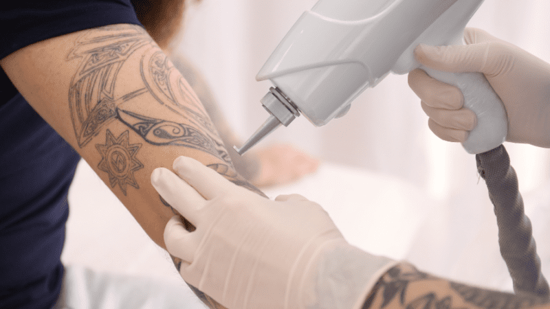 tattoo removal in bangalore